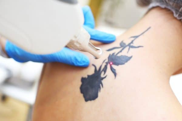 Tatoeage verwijderen met de Pico Laser Spot bij Beautylink