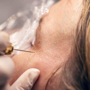 Plasmapen cursus met apparaat bij BeautyLink