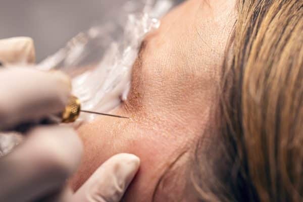 Plasmapen cursus met apparaat bij BeautyLink